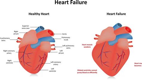 global hypokinesia of the left ventricle